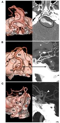 Prospects and Dilemmas of Endovascular Treatment for Vertebrobasilar Dolichoectasia